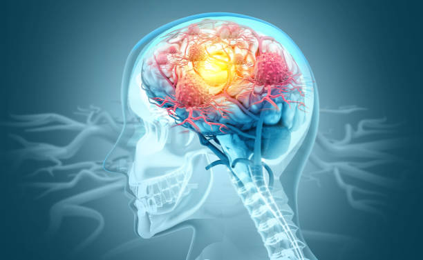 Cancer cells attacking a human brain. 3d illustration