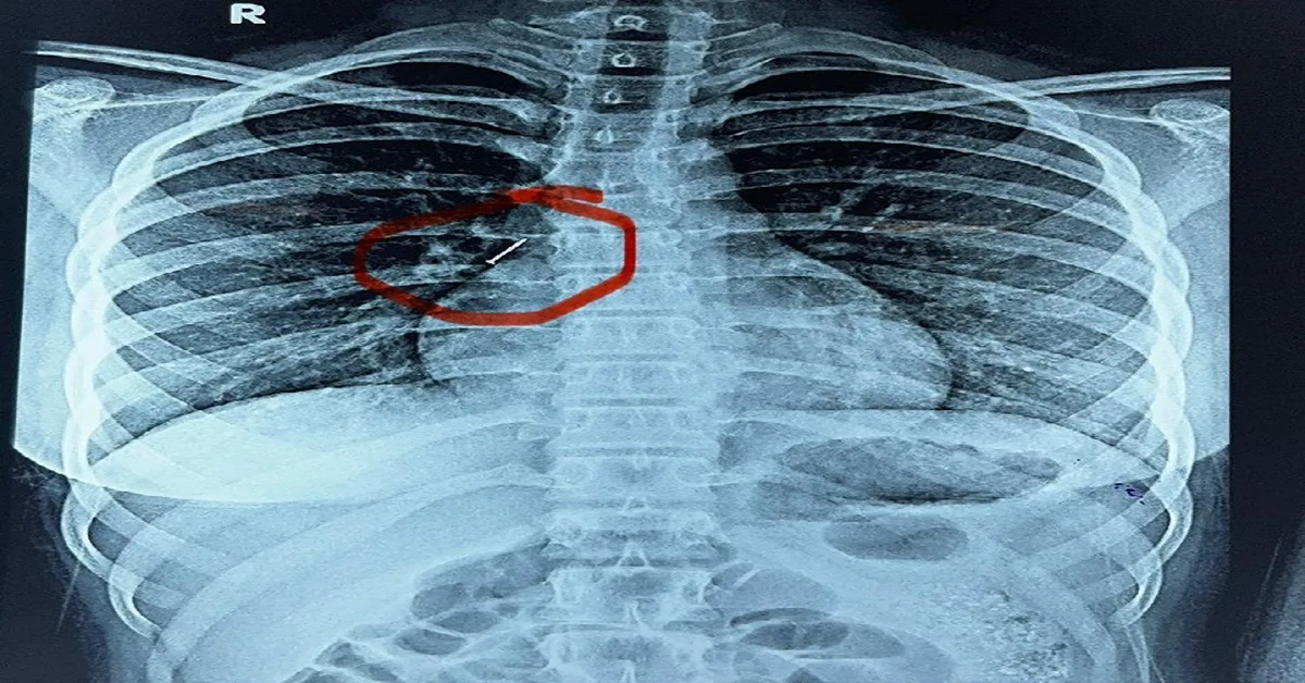 Ahmedabad Civil Hospitalમાં ચમત્કાર, શ્વાસનળીમાંથી સેફ્ટી પિન કાઢી 13 વર્ષની બાળકીનો જીવ બચાવ્યો